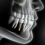 diagram of dental implants in La Porte after placement