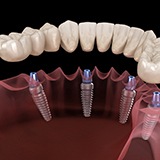 All-On-4 implant-retained denture.