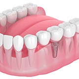 Illustration of single dental implant