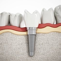 Diagram of dental implants in La Porte