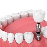 Diagram of how dental implants in La Porte work