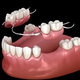 partial denture replacing missing teeth
