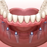 six dental implants supporting a full denture