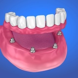 Model of implant-retained denture