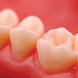Close-up of tooth-colored fillings