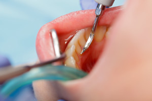 Do you need a gum disease treatment in La Porte?