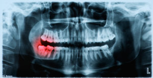 x-ray image of inflamed tooth