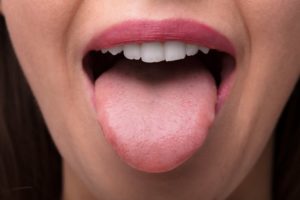 Kakadu Lure tæt Dentist in La Porte | White Spots on Tongue | Dr. Daniel Berquist