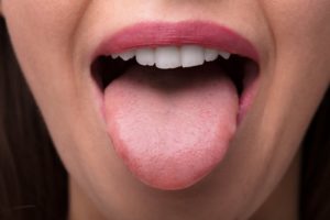 How To Get Rid Of White On Tongue