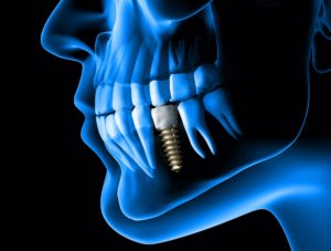 Digital implant of a dental implant in La Porte.