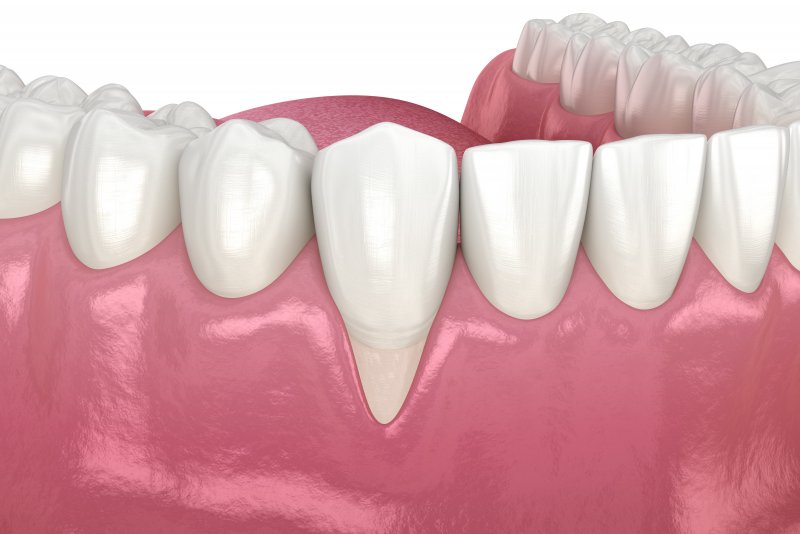 3D rendering of gum recession