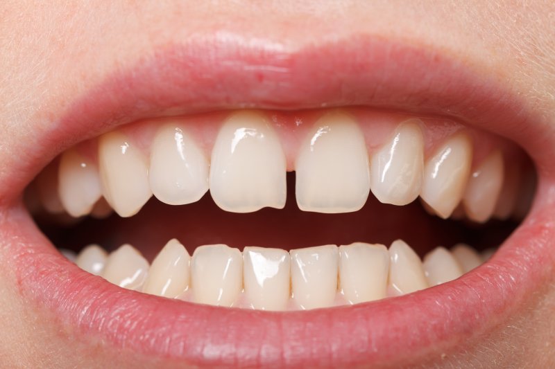 A closeup of a gap between front teeth
