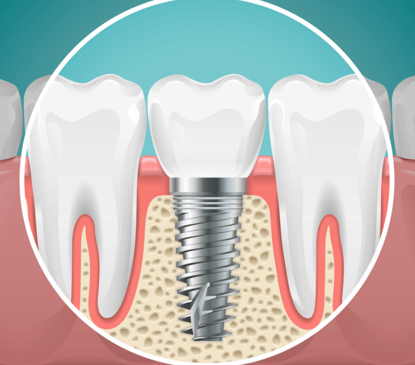Illustrated cross section of a dental implant
