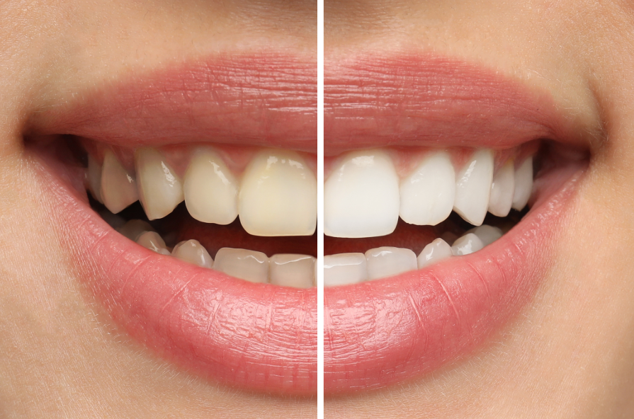 Close up of woman's smile, half yellow teeth, half white teeth